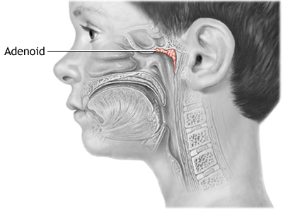 Adenoids